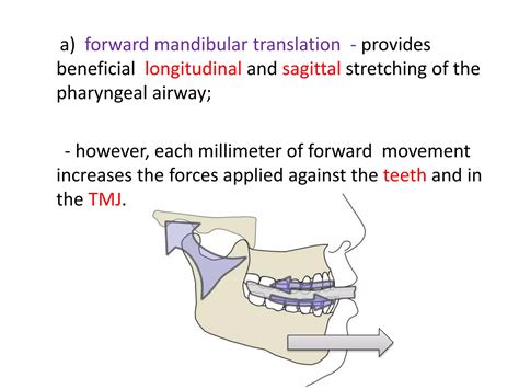 Role Of Mandibular Advancement Splint In Sleep Apnoea PPT