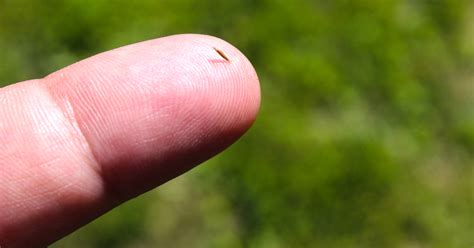 5 Secret Methods To Safely Remove A Splinter Without Ever Reaching For Tweezers