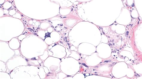 Lipoma Vs Liposarcoma Histology