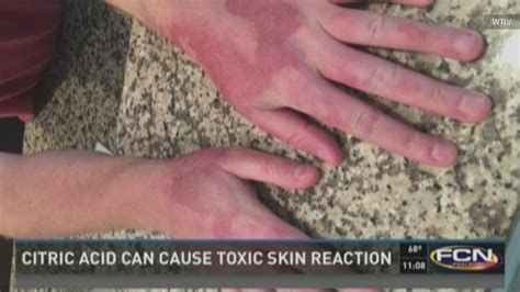 Limes Sun Cause Second Degree Burns On Florida Mans Hands During Margarita Making Session