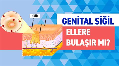 Genital Siğiller Bulaşıcı Mı El Siğilleri Kimlerde Görülür YouTube