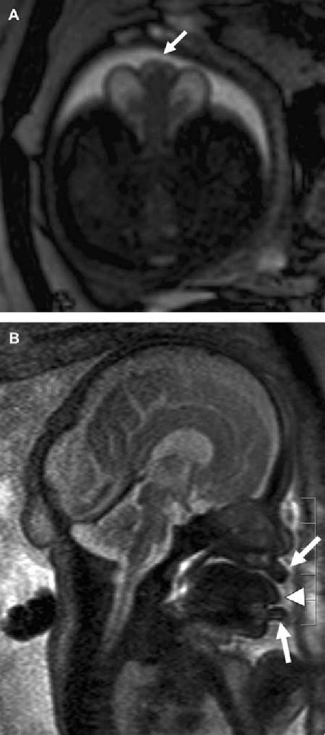 Figure From Abnormalities Of The Penis In Utero Hypospadias On