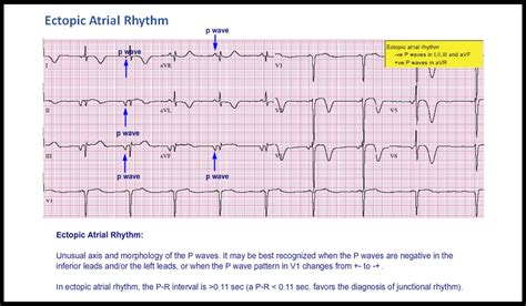 T29 Ectopic Atrial Rhythm Ecg Made Simple