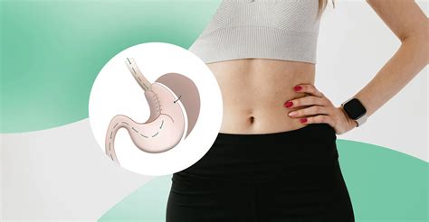 Soluciones Efectivas Para Reflujo Y Hernia Hiatal