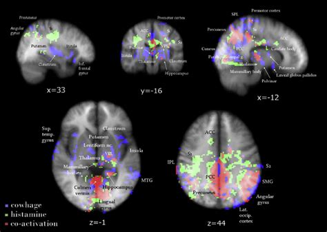 Brain Activity During Histaminergic And Nonhistaminergic Itch Stimuli