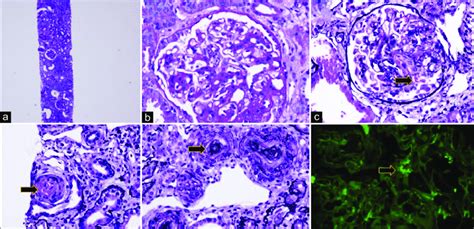 Renal Biopsy Of The Patient A Tubulointerstitial Nephritis B