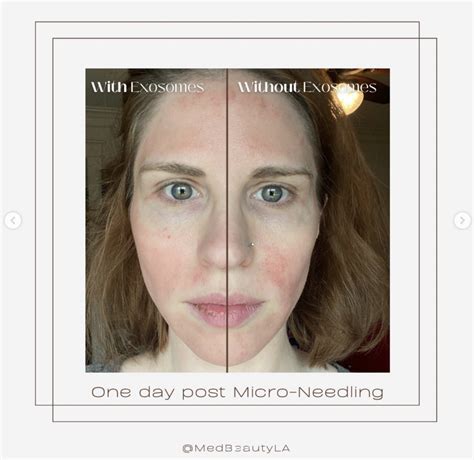 Microneedling Exosomes Before And After Photos Medbeautyla