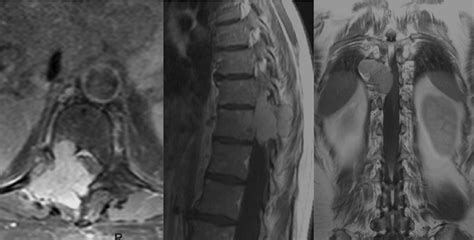 Magnetic Resonance Imaging Of The Thoracic Spine Showing A Solitary Download Scientific Diagram