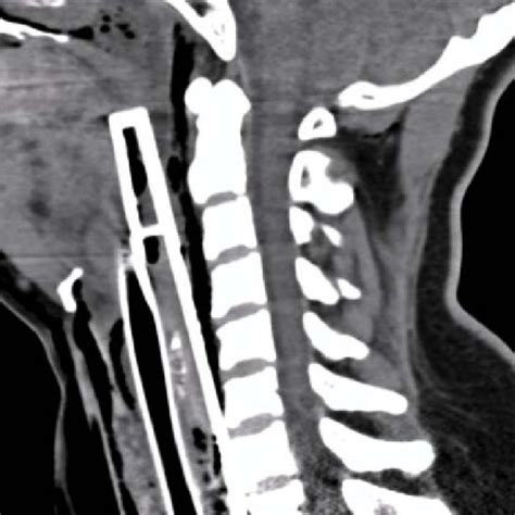 Cervical Esophageal Perforation Primary Repair With Omohyoid Muscle