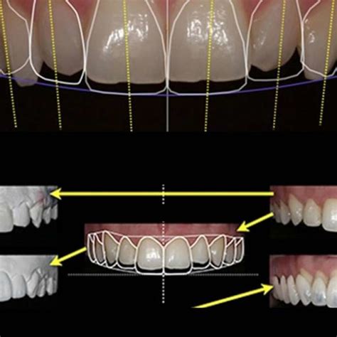 Anveli Dental Facette Dentaire