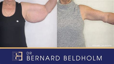 Brachioplasty Arm Lift Surgery Before And After Results