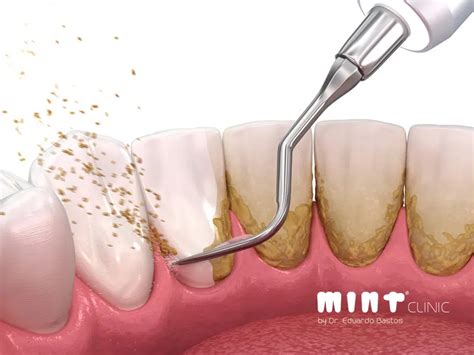 Qual A Diferen A Entre Placa Bacteriana E T Rtaro Nos Dentes Cl Nica