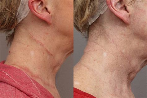 Microneedling Before And After Results Impressions Medispa