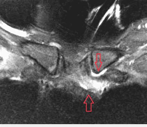 Magnetic Resonance Imaging Of The Chest Showing Osteomyelitis In The