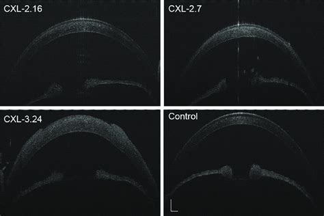 Anterior Segment Optical Coherence Tomography Uhr Oct Scan Visualized