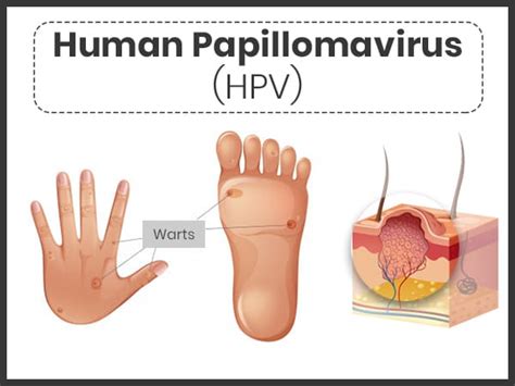 Human Papillomavirus HPV Infection Symptoms Causes Risk Factors