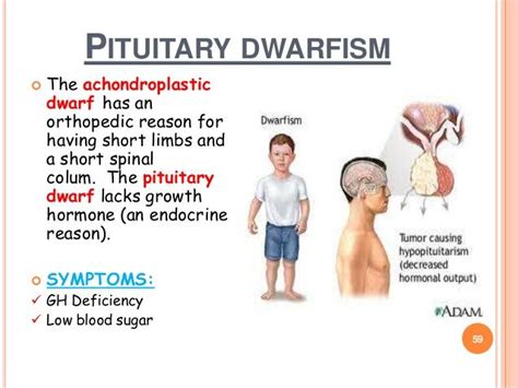 proportionate dwarfism - Google Search | Endocrine disorders, Endocrine system, Endocrine