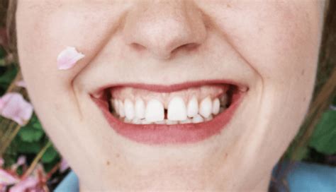 Gap Teeth Fix – How to Fix Gaps in Teeth from Home - PressOn Veneers ...