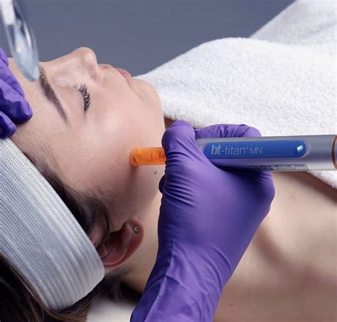 What Nano Needling Is And Why You May Need It Stonebriar Spa Frisco Tx