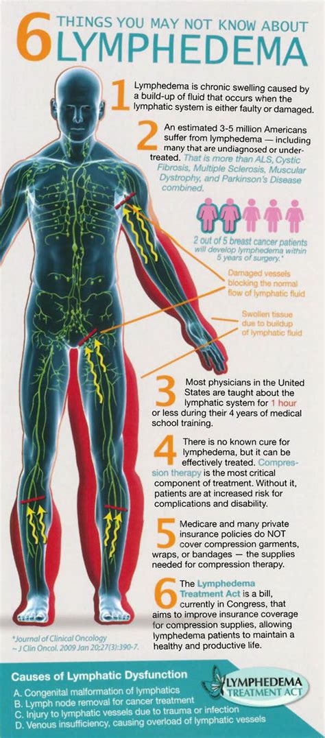 Lymphedema treatment – Artofit