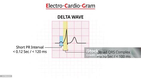 Delta Wave Ecg Morphology Electrocardiogram Stock Illustration ...