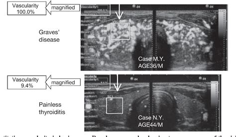 Figure 1 From Study On Cutoff Value Setting For Differential Diagnosis