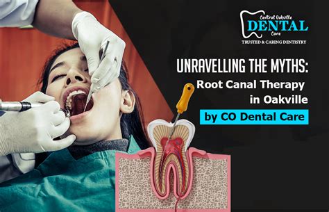 Unraveling The Myths Root Canal Therapy In Oakville By CO Dental Care