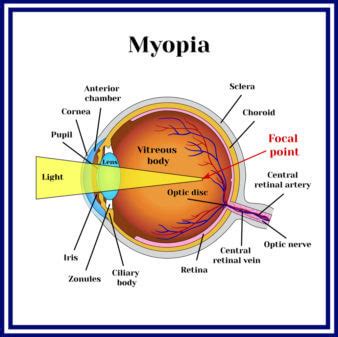 Myopia : Causes, Symptoms, Diagnosis, Types and Treatment