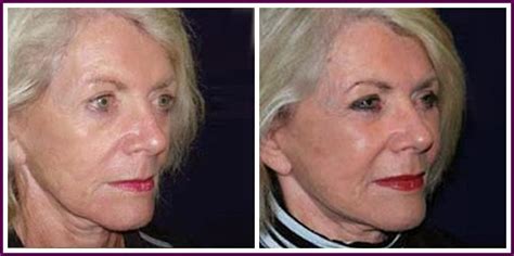 Obtaining A Chinese Acupressure Facelift With Face Aerobics Workouts ...