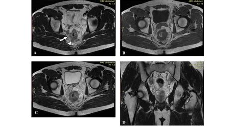 Year Old Male With Pathologically Proven T Stage Rectal Carcinoma