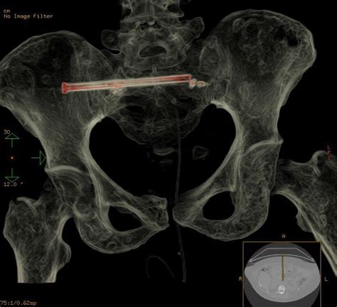 Saudi hospital repairs woman's pelvic fracture without surgery - Eye of ...