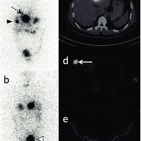 Anterior A And Posterior B View Of Whole Body Scan Wbs With