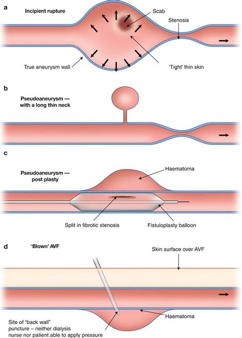 Pseudoaneurysm Av Fistula