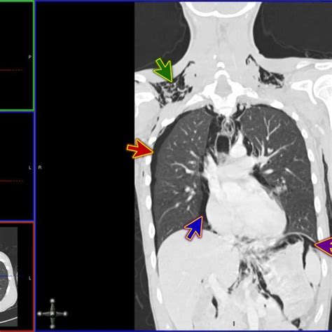 Contrast Ct Of Neck And Thorax Showing Pneumomediastinum Blue Arrow