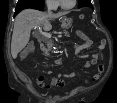 Eus Guided Hepaticojejunostomy With Transjejunal Per Oral