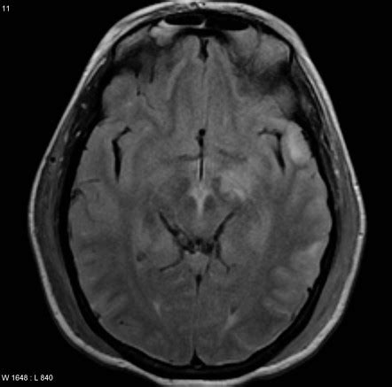 Diffuse Axonal Injury Grading Radiology Reference Article