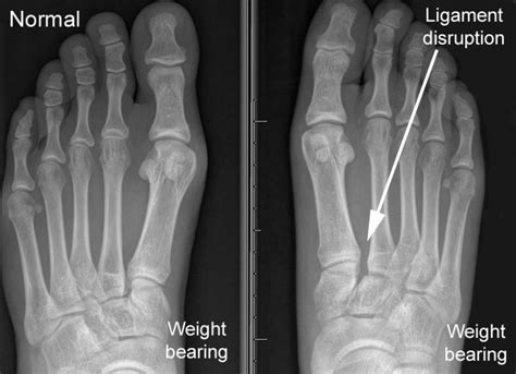 Lisfranc Fracture - Drwolgin