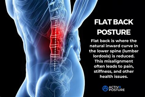 Flat Back - Activ8 Posture