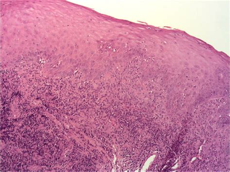 Histopathological Verification Hematoxylin And Eosin Of The Olp