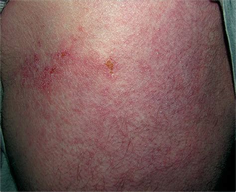 Dermatomyositis Induced By Antitumor Necrosis Factor In A Patient With