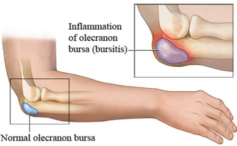 Elbow (Olecranon) Bursitis: Symptoms, Causes Treatment, 55% OFF