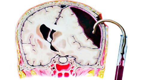 Drenaje De Hematoma Subdural Agudo Mind Map