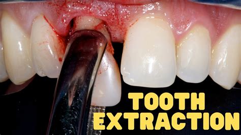 Tooth Extraction Explained Wisdom Teeth Extraction Aftercare Youtube