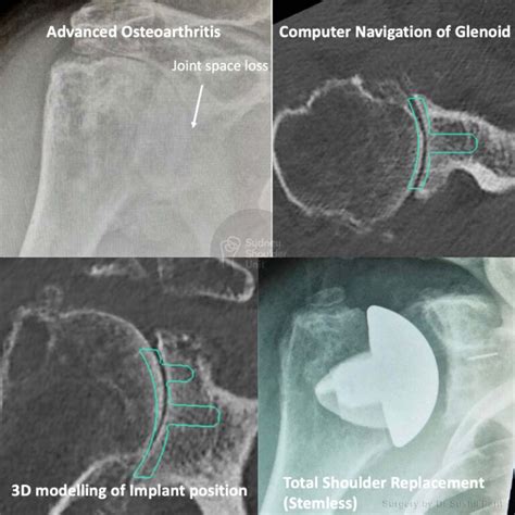 Total Shoulder Replacement Medical Case Study Sydney Shoulder Unit