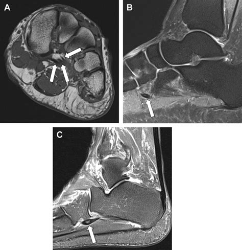 Normal Anatomy And Mr Imaging Pitfalls Of The Peroneus Longus Tendon