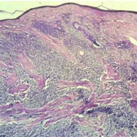 Photomicrograph Showing Sheets Of Inflammatory Cell Infiltrates And