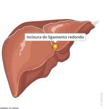 Ligamento Redondo Do Figado - Incisura do ligamento redondo - e-Anatomy - IMAIOS