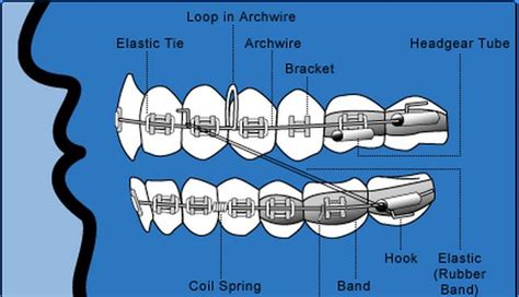 Braces Diagram Allcare Orthodontic Center