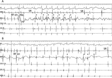 Development Of Accelerated Ectopic Atrial Cycles During Radiofrequency Download Scientific