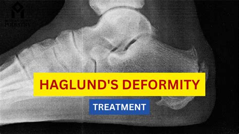 Haglunds Deformity A Chiropractic Treatment Guide